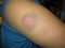 bruised arm